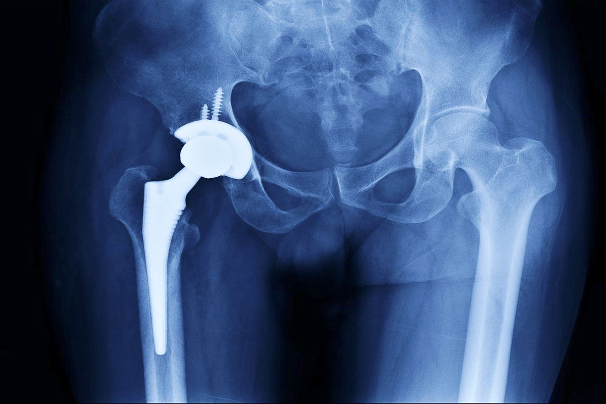 Hip Replacement Surgery in Greater Noida
